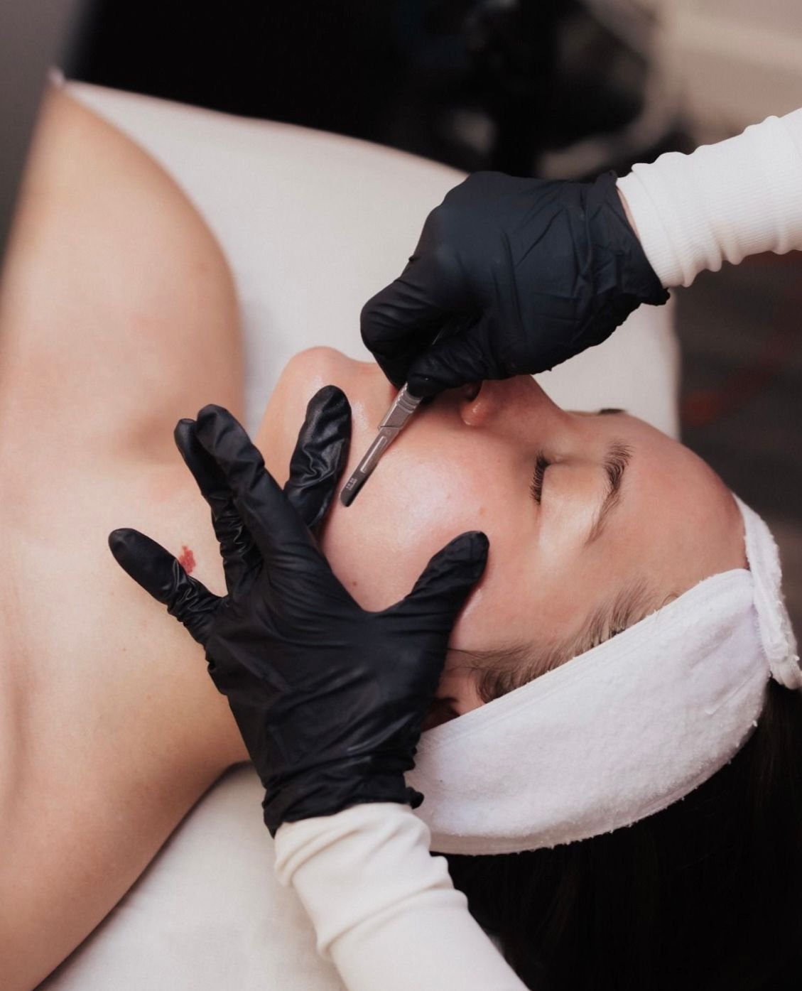 Dermaplaning profesional